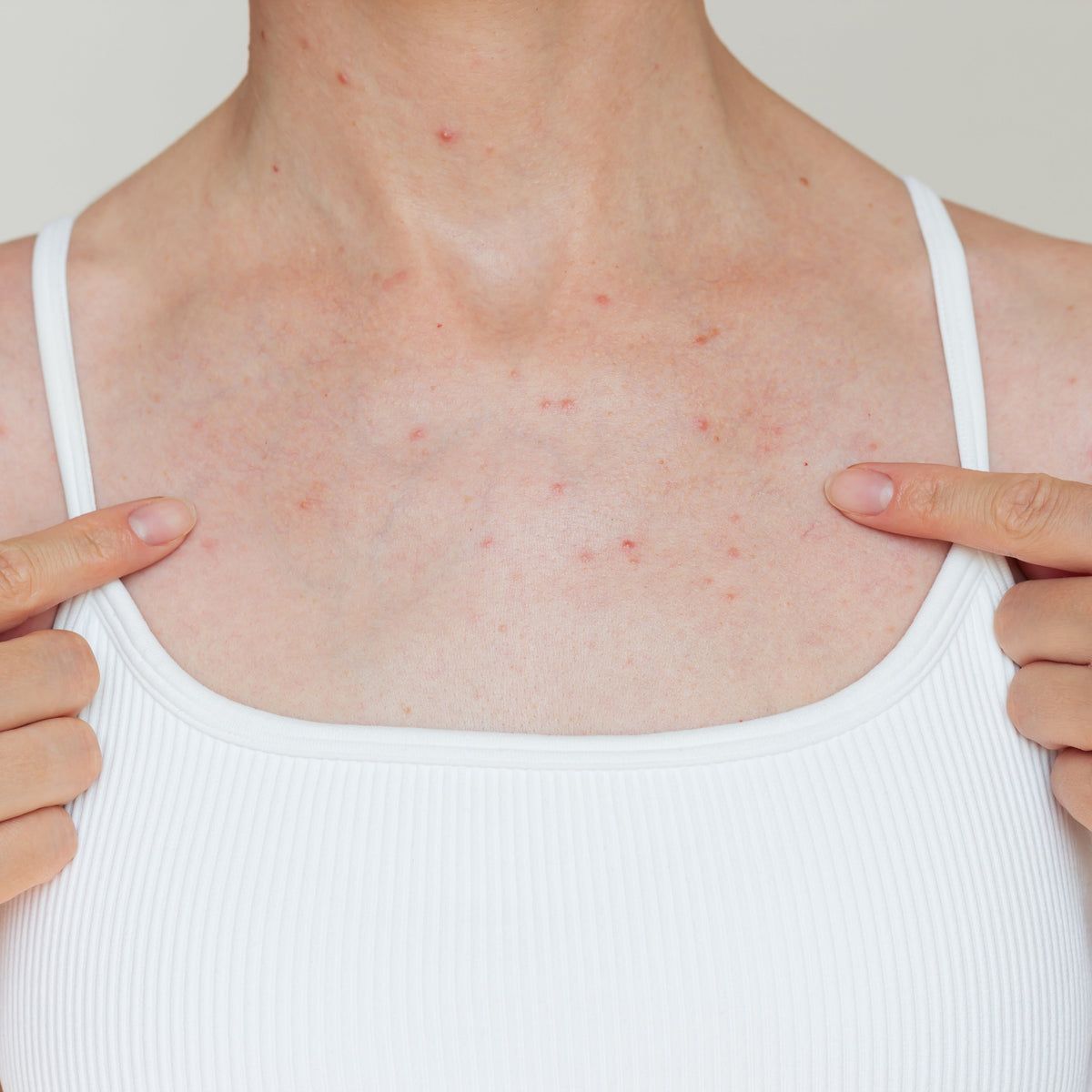 Can I Get a Spray Tan If I Have Sensitive Skin?